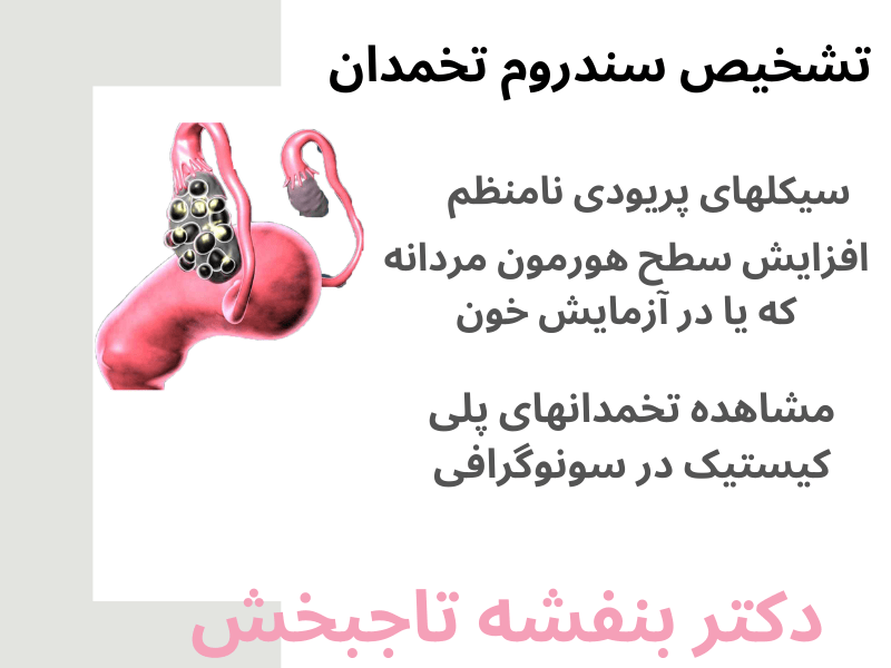 تشخیص-سندروم -تخمدان