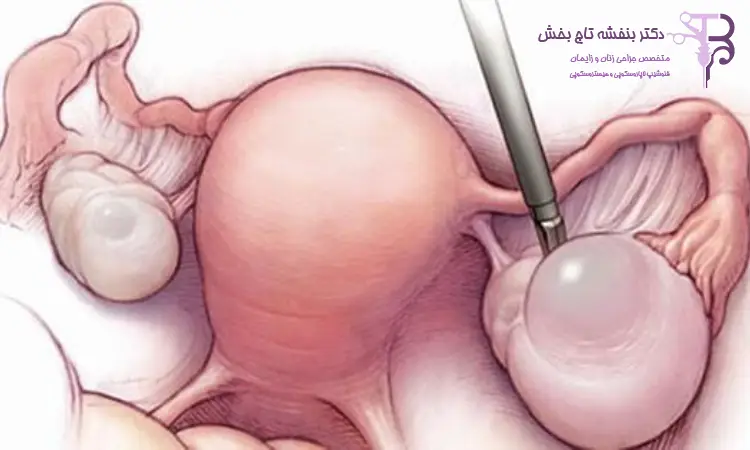 لاپاراسکوپی کیست تخمدان چیست؟