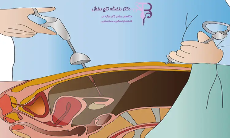 راه‌های کاهش درد بعد از جراحی لاپاراسکوپی