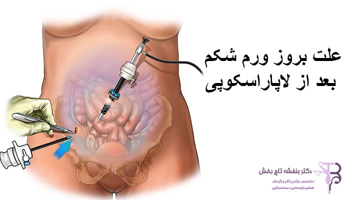 علت بروز ورم شکم بعد از لاپاراسکوپی