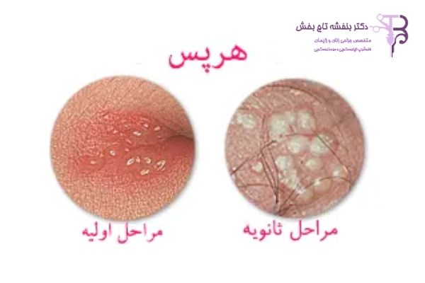 تبخال تناسلی زنان چه خطراتی دارد؟