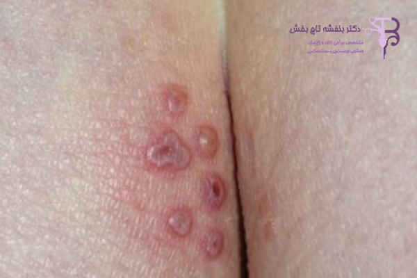 عوامل موثر بر ایجاد تبخال تناسلی
