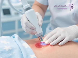 لیزر زگیل تناسلی