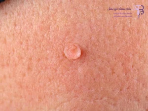 علائم زگیل تناسلی