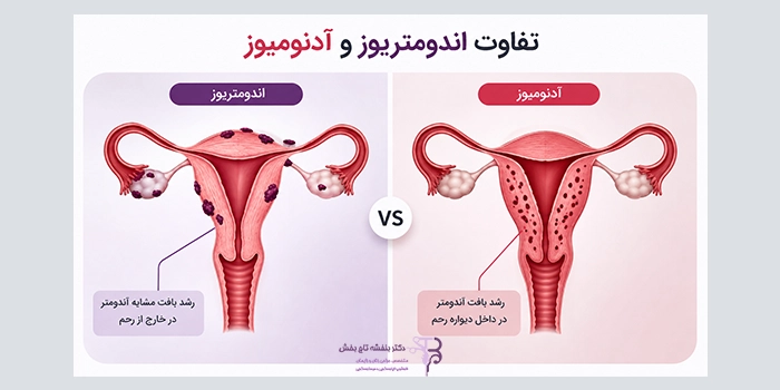 تفاوت اندومتریوز و آدنومیوز چیست؟ بررسی علائم و درمان