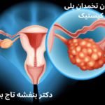 درمان-تخمدان-پلی-کیستیک