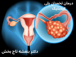 درمان-تخمدان-پلی-کیستیک