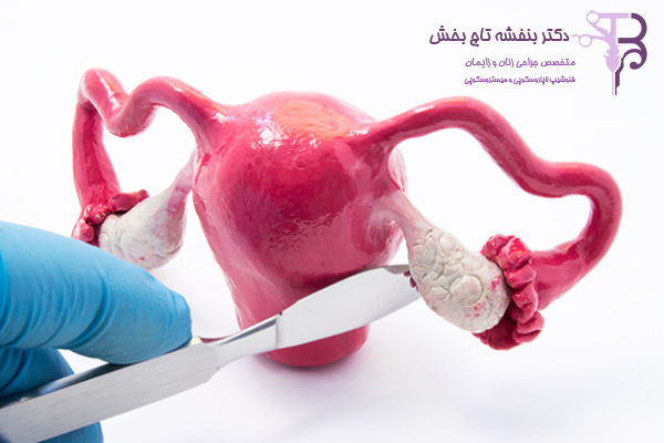 روش‌های درمان تراتوم تخمدان