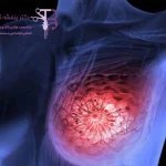 فیبروکیستیک - شاخص