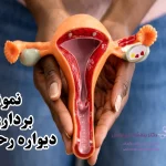 نمونه برداری دیواره رحم