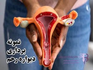 نمونه برداری دیواره رحم