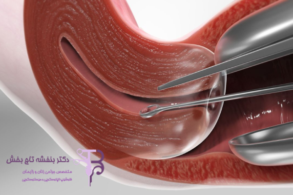 چه زمانی نمونه برداری اندومتر توصیه می‌شود؟