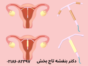 جراحی-هیستروسکوپی