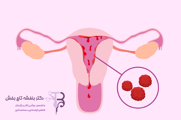 سندروم تخمدان پلی‌کیستیک (PCOS)