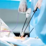 جراحی لاپاراسکوپی آندومتریوز