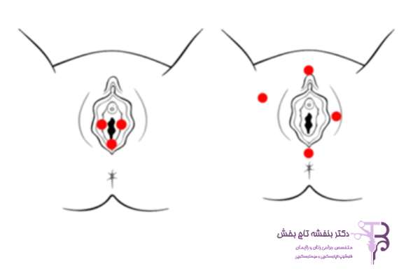 تشخیص ولوودینیا