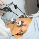 هیستروسکوپی میومکتومی