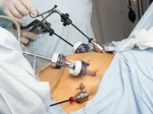 هیستروسکوپی میومکتومی