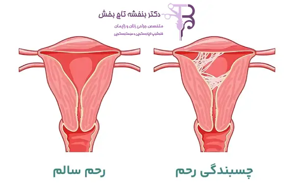 لوله فالوپ یا لوله رحمی چیست؟