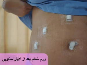 ورم شکم بعد از لاپاراسکوپی