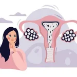ورزش بعد از لاپاراسکوپی