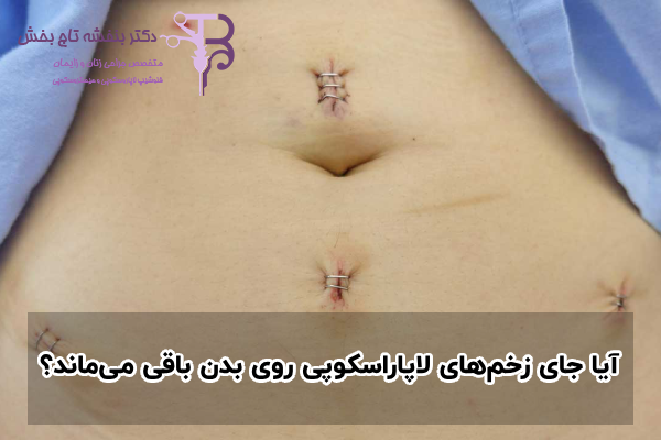 آیا جای زخم‌های لاپاراسکوپی روی بدن باقی می‌ماند؟