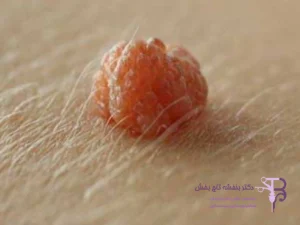 راه های انتقال زگیل تناسلی: زگیل تناسلی از چه راهی منتقل می‌شود؟