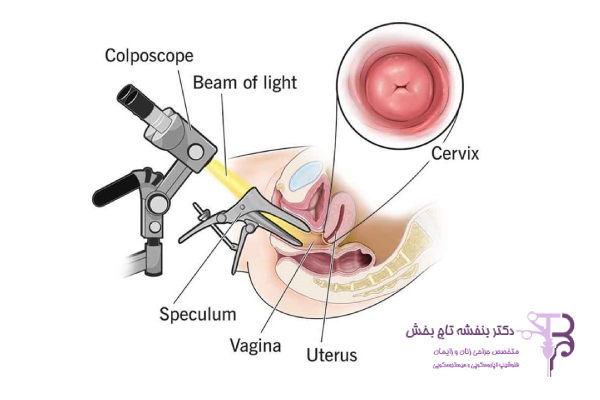 چرا کولپوسکوپی بعد از زایمان اهمیت دارد؟