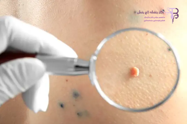 آیا لیزر زگیل تناسلی، ویروس HPV را کامل از بین می‌برد؟