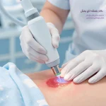 لیزر زگیل تناسلی