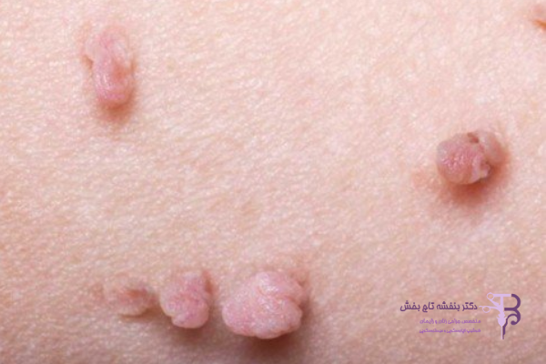 معایب و عوارض احتمالی لیزر زگیل تناسلی