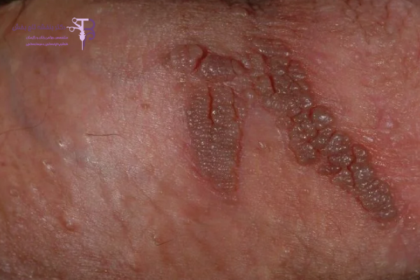 علائم زگیل تناسلی پنهان و بدون ضایعه