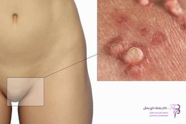 محلهای شایع بروز زگیل تناسلی